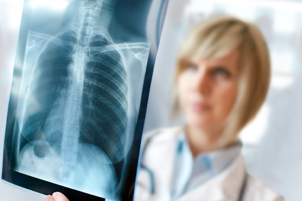 Recognizing and Managing Lung Cancer: Key Signs and Treatment Strategies