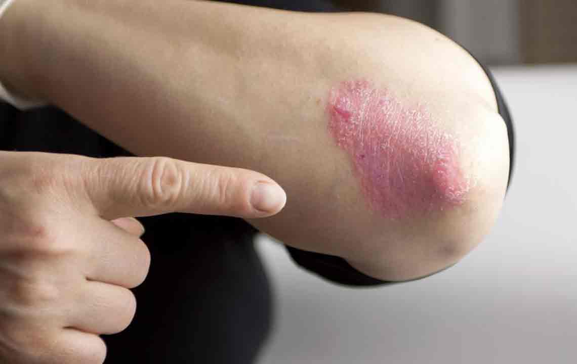 Effective Strategies for Managing and Treating Psoriasis