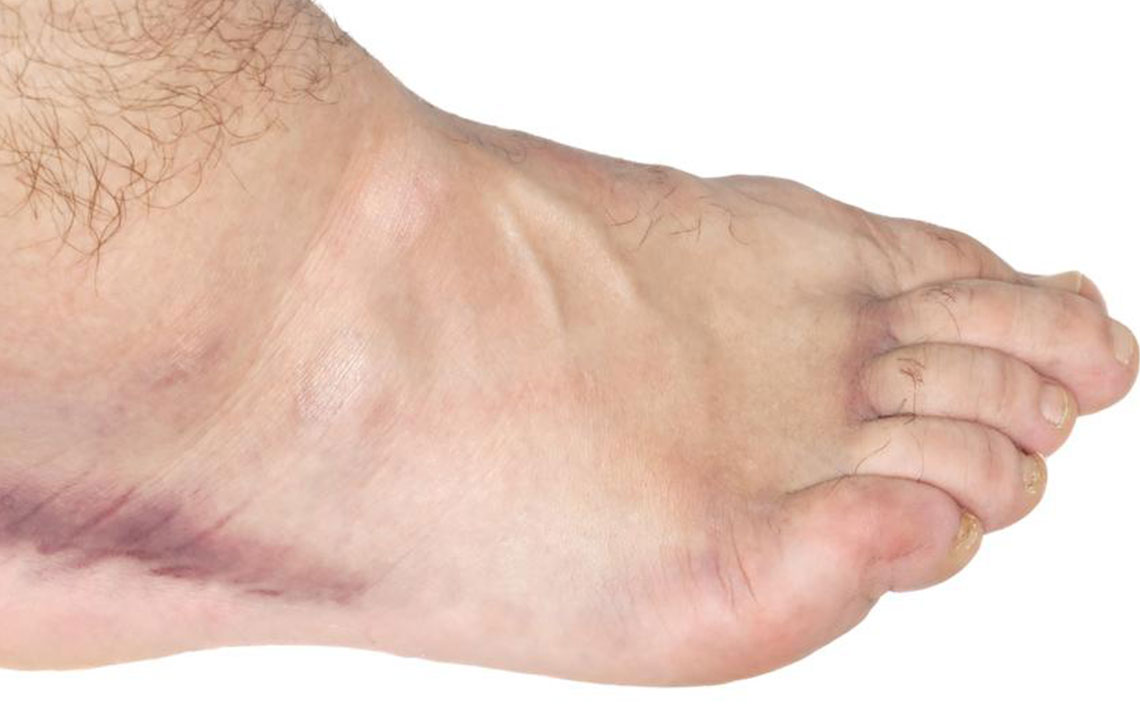 Effective Strategies to Alleviate Swollen Ankle Discomfort