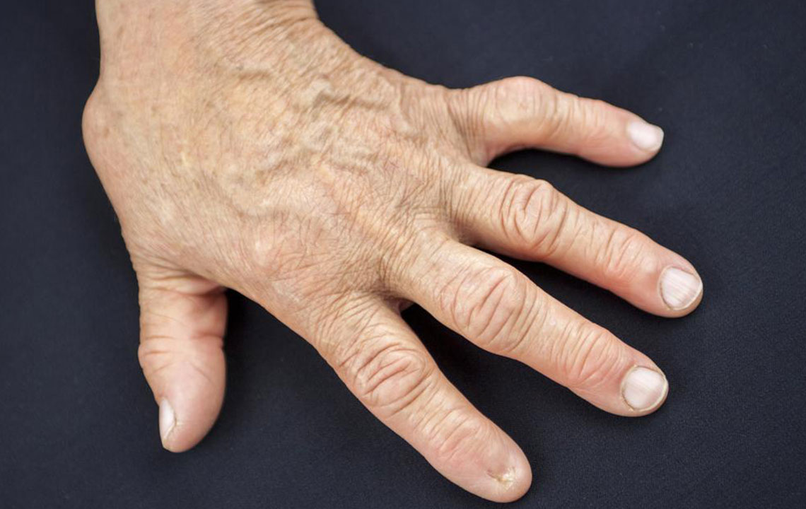 Key Indicators of Rheumatoid Arthritis to Watch For