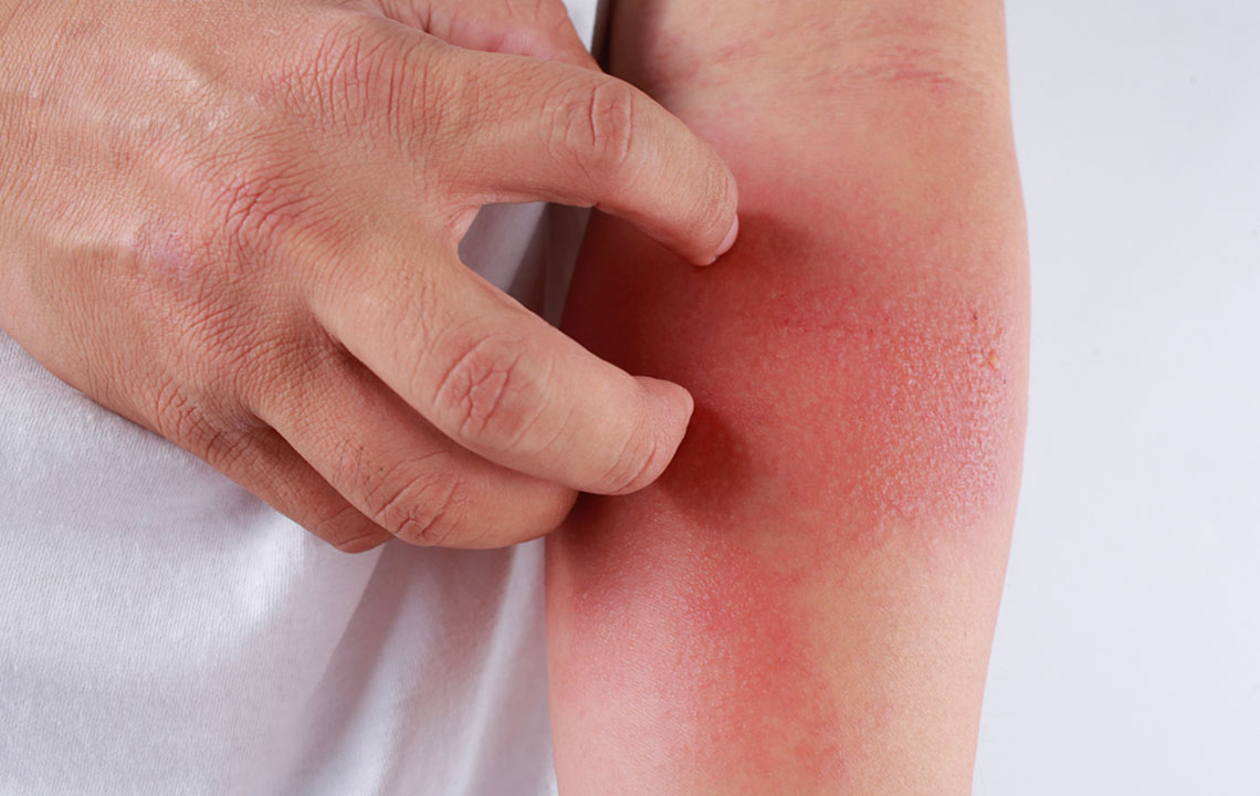 Effective Strategies for Recognizing and Managing Skin Rashes