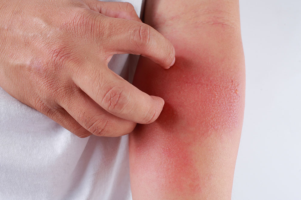 Effective Dietary Strategies for Eczema Management