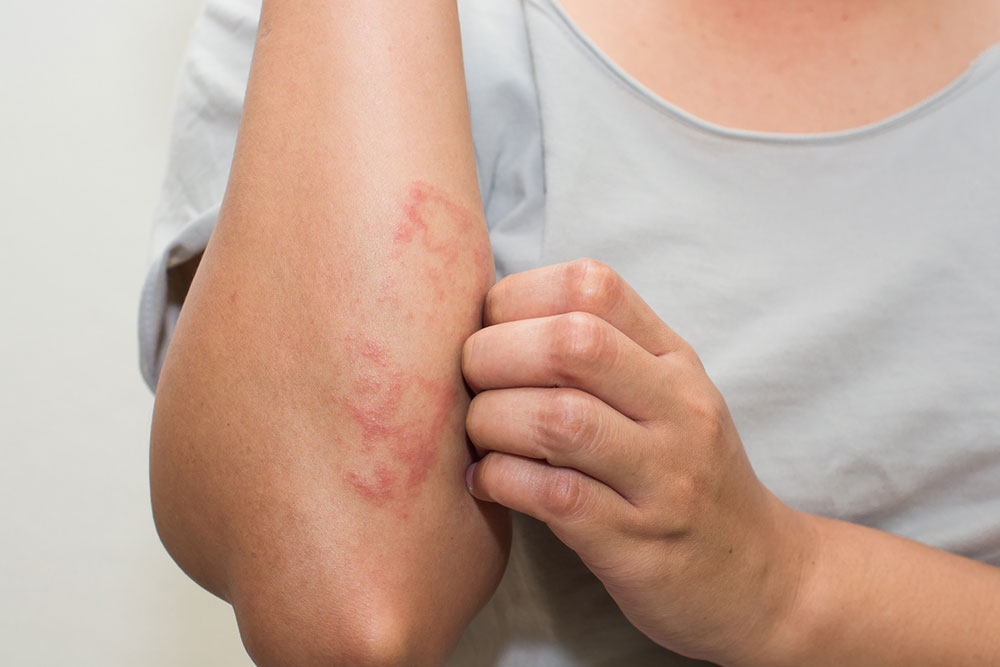 Understanding Eczema: Types, Symptoms, and Effective Treatments