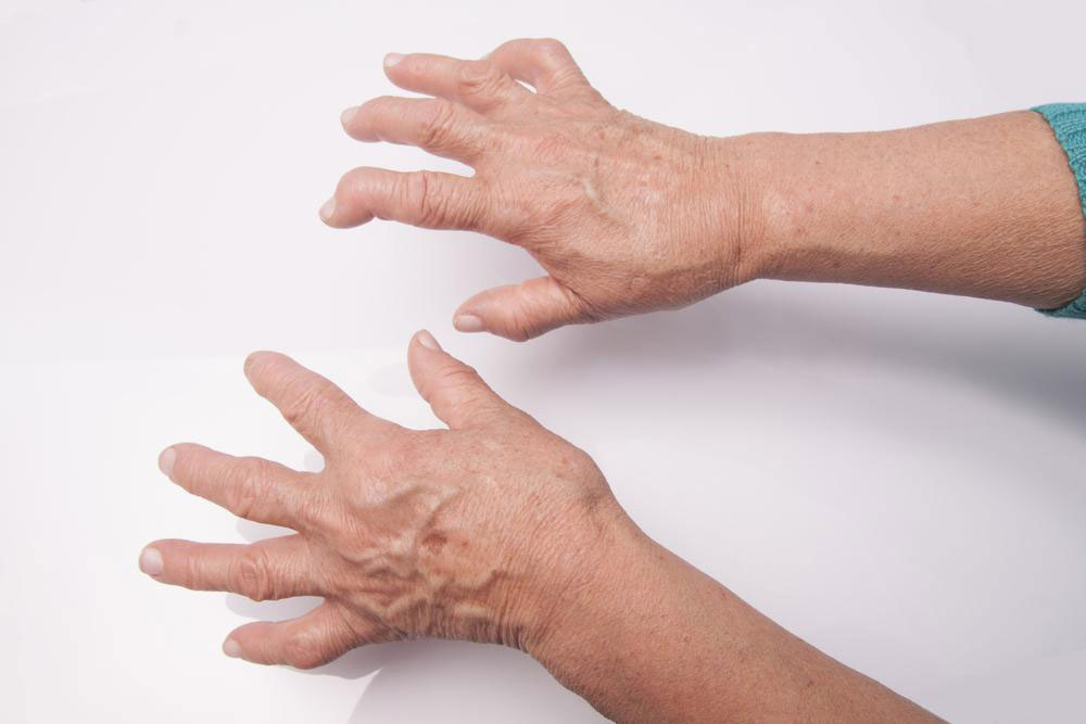 Essential Medications for Managing Rheumatoid Arthritis