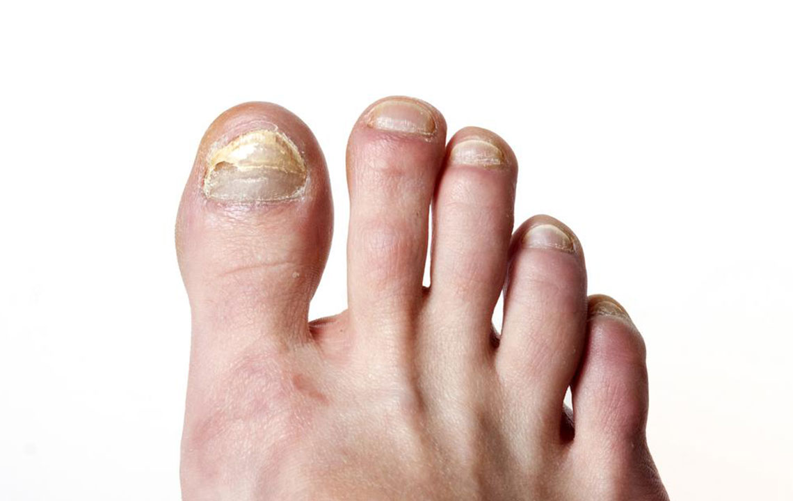 Effective Natural Remedies for Toenail Fungal Infections